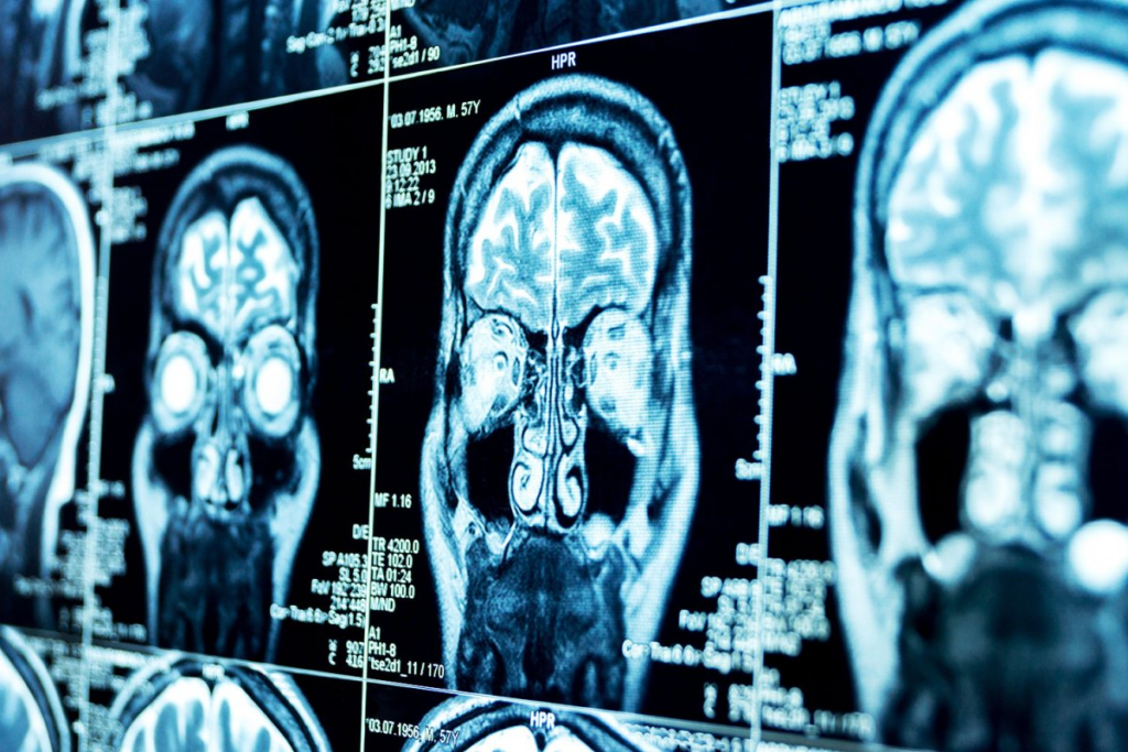 ជំងឺមេនីងហ្គូកកូកាល់