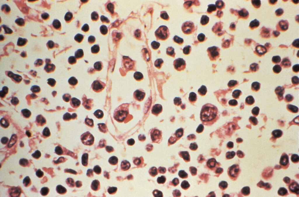 ការធ្វើចត្តាឡីស័ក Hantavirus