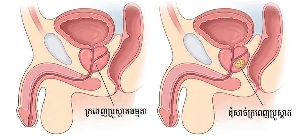 មន្ទីរពេទ្យហ្លួងម៉ែ ប្រាប់ពីរោគសញ្ញាសំខាន់ៗនៃជំងឺមហារីកក្រពេញប្រូស្តាត ដែលបុរសគ្រប់រូបគួរយល់ដឹង